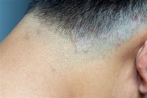 Ringworm On Scalp Behind Ear