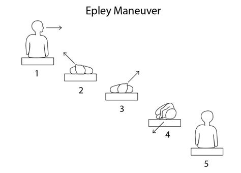 [Figure, Diagram showing the steps of the Epley maneuver. Contributed by Rian Kabir, MD ...