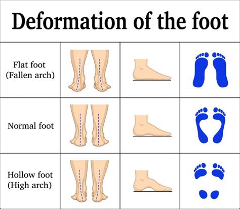 Orthotic Insoles -- Rehabilitation and Nursing for Common Foot Diseases | EVA Orthotic Insoles ...