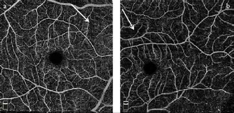 OCT Angiography of OD (a) and OS (b) at 10-day follow-up exhibiting ...