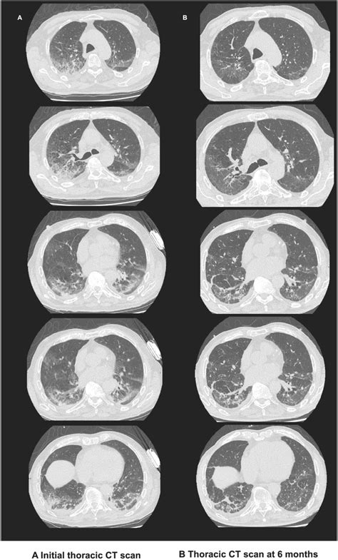 Thoracic CT scan of an 81‐year‐old male with severe COVID‐19 at ...