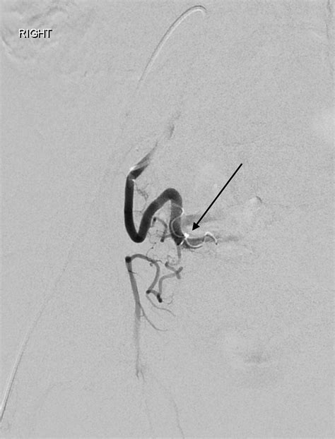 Variant obturator artery complicating uterine artery embolization ...