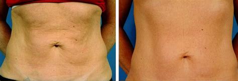 Coolsculpting vs Thermage vs Exilis ⋆ Precision Aesthetics MD