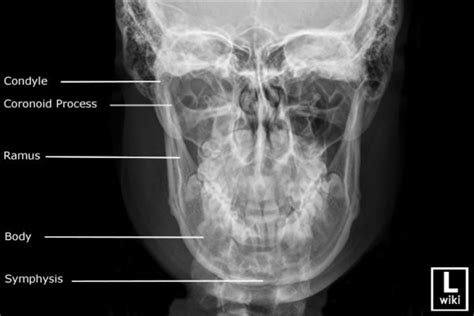 Mandible x-rays