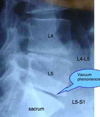 Back surgery alternatives should always be considered first.