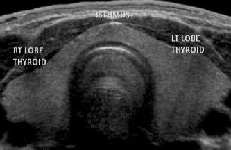 Normal Thyroid Gland Ultrasound