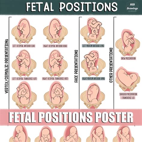 Fetal Postions in the Uterus Poster - Etsy