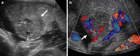 Chorioangioma. a Long-axis gray-scale ultrasound image of the placenta ...