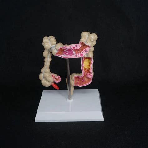 Anatomical Human Colon large Intestine Pathological Diseases Model ...