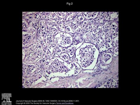 Paraganglioma of the hypoglossal nerve - ppt download