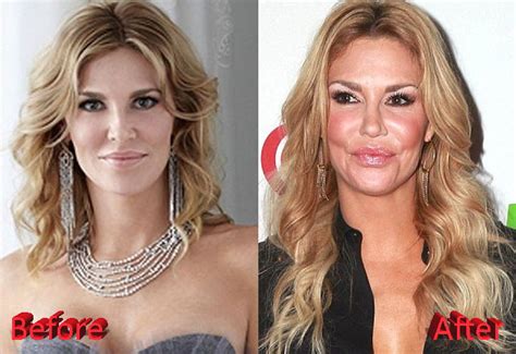 Brandi Glanville Plastic Surgery: A Botox Overdose