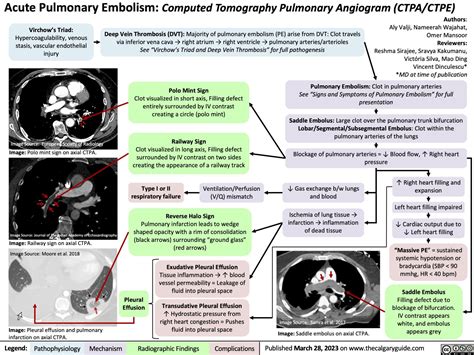 Acute Pulmonary Embolism: Computed Tomography Pulmonary Angiogram (CTPA/CTPE) | Calgary Guide