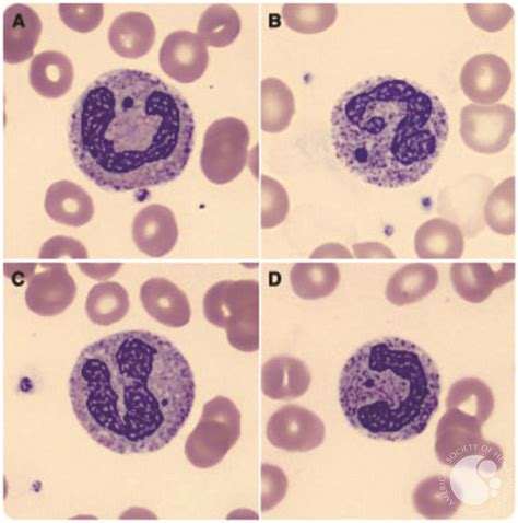 Howell-Jolly–like bodies in neutrophils