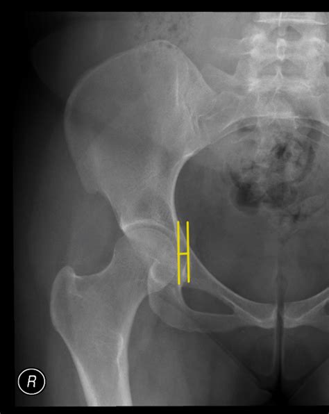 Male with coxa profunda (acetabular depth is of 6 mm).... | Download ...