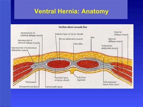 Ventral Hernia: Challenges and Choices