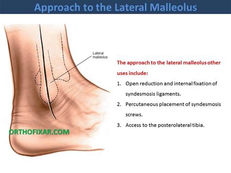 Approach To The Lateral Malleolus • OrthoFixar 2024