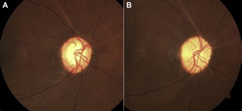 Reversal of Optic Nerve Head Cupping - Ophthalmology Glaucoma