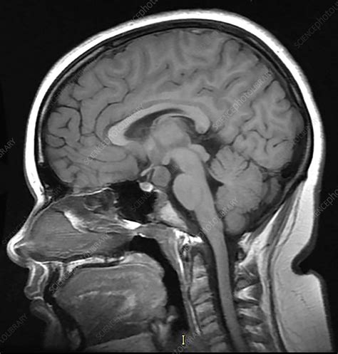 Hypothalamic Hamartoma, MRI - Stock Image - C030/6379 - Science Photo ...