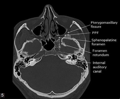 Axial CT bone window of skull base from inferior to superior aspect ...