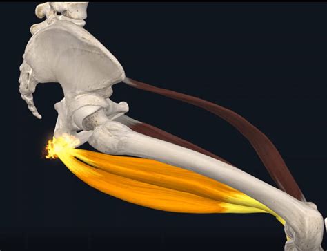 Proximal Hamstring Tendinopathy | Advantage Sport Medicine