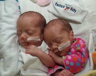 Monoamniotic Twins: Rare monoamniotic twins delivered at Packard Hospital