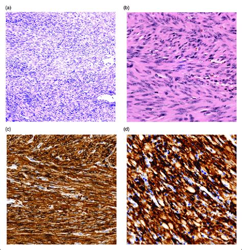 (a) Histopathology of the tumor. The tumor is a spindle cell neoplasm ...