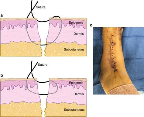 What type of suture/stitches is the best generally? | Survivalist Forum