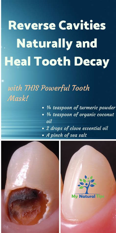 How To Heal Tooth Decay And Reverse Cavities – Naturally! | Tooth decay ...