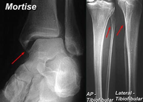 High Ankle Sprain & Syndesmosis Injury - Foot & Ankle - Orthobullets