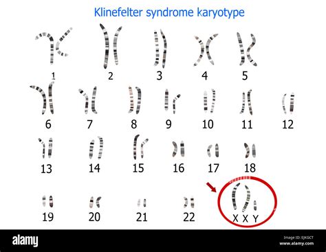Cariotipo del síndrome fotografías e imágenes de alta resolución Alamy