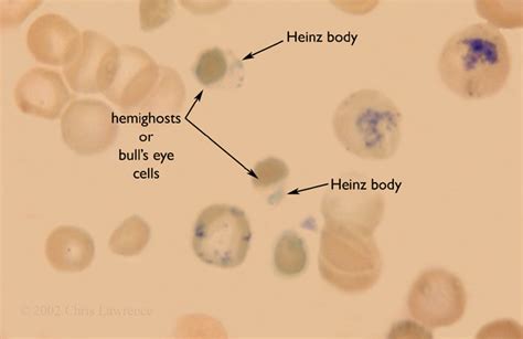 Heinz Bodies in G6PD Hemolysis | Eccles Health Sciences Library | J ...