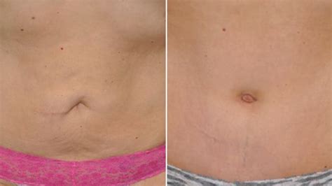 Belly button makeovers: Computers help define the 'perfect' navel