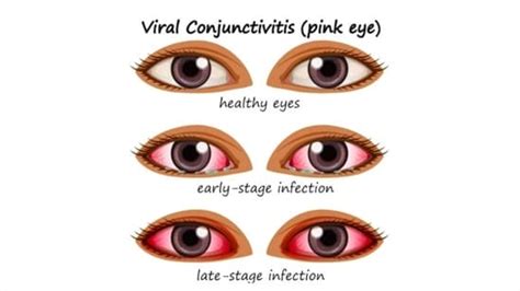 Conjunctivitis: Causes, how it spreads, treatment, prevention tips ...