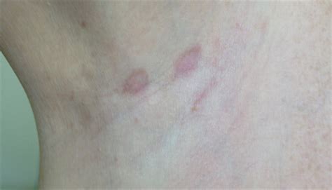 Circular Rash Under Armpit