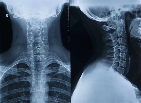 Cervical Rib: Anatomy, Associated Conditions, Treatment