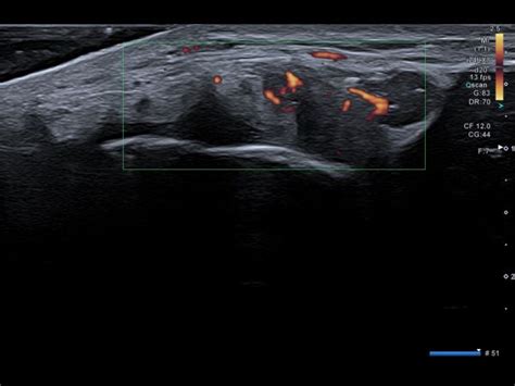 Partial tear common extensor tendon | Ultrasound Cases