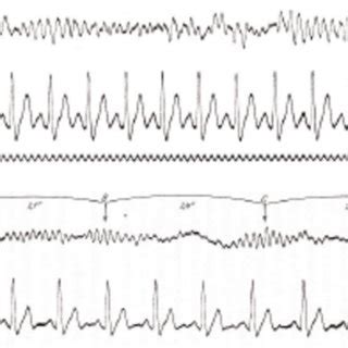 (PDF) Brain Waves, A Cultural History: Oscillations of Neuroscience, Technology, Telepathy, and ...