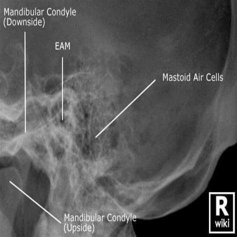 X-Ray Mastoid Lateral View | Test Price in Delhi | Ganesh Diagnostic