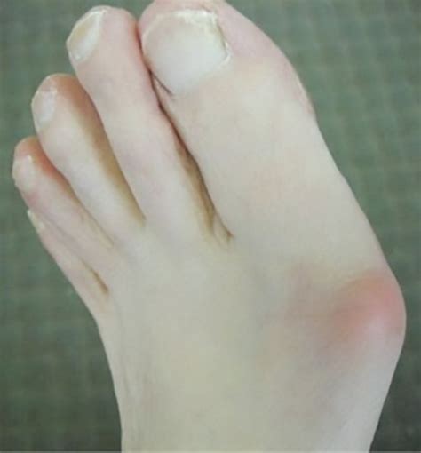 Bunions | Causes and treatment options | MyFootShop.com