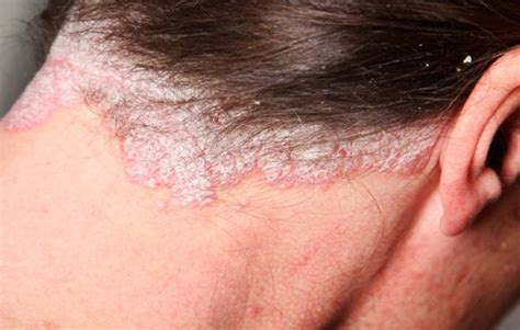 Psoriasis Treatment in York, PA | Dermatology Associates of York, Inc.