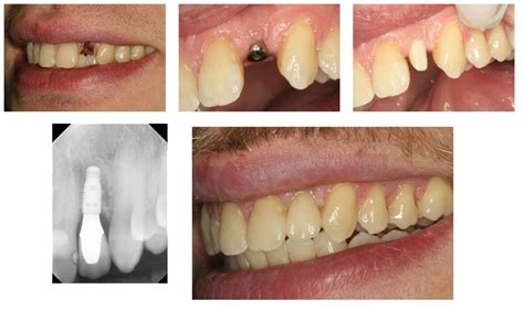 Dental Implants: The Best Way to Replace a Single Tooth