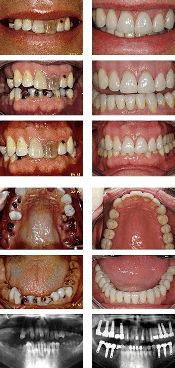 how to remove a rotten tooth - marineaujeane