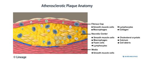 Atherosclerosis - Cardiovascular - Medbullets Step 1