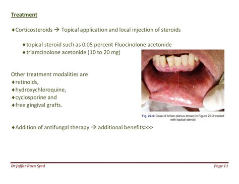 022.desquamative gingivitis