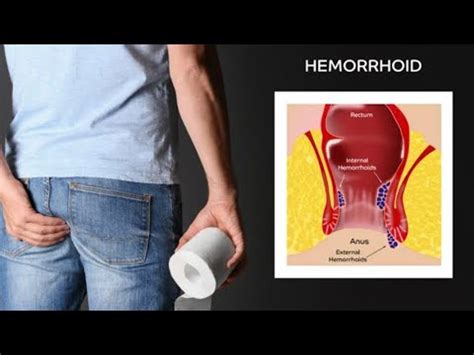 Haemorrhoids-diagnosis,investigation,complications,conservative treatment,haemorrhoidectomy ...