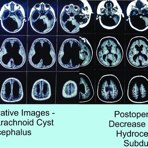 Preoperative retrocerebellar arachnoid cyst with hydrocephalus and... | Download Scientific Diagram