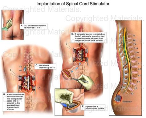 Implantation of Spinal Cord Stimulator : Medical Exhibit | Spinal cord ...