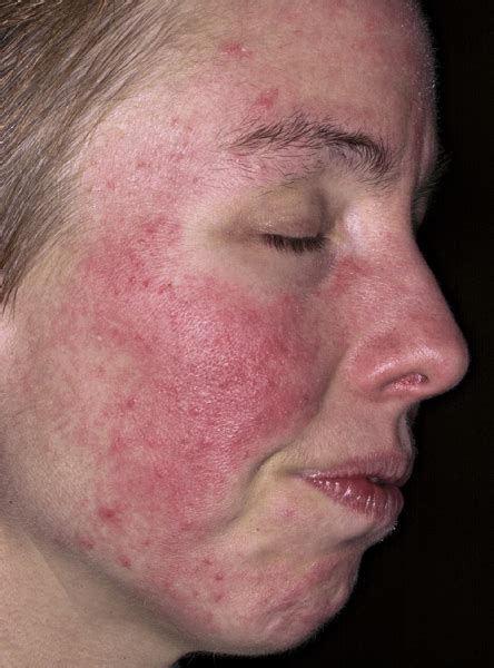 Acne Rosacea - Causes, Symptoms, Treatment, Pictures, Diet | Diseases Pictures