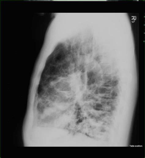 Cystic Bronchiectasis on Chest X-ray - X Rays Case Studies - CTisus CT ...