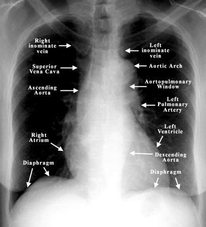 Chest Radiology | Radiology, Radiology technician, Medical radiography